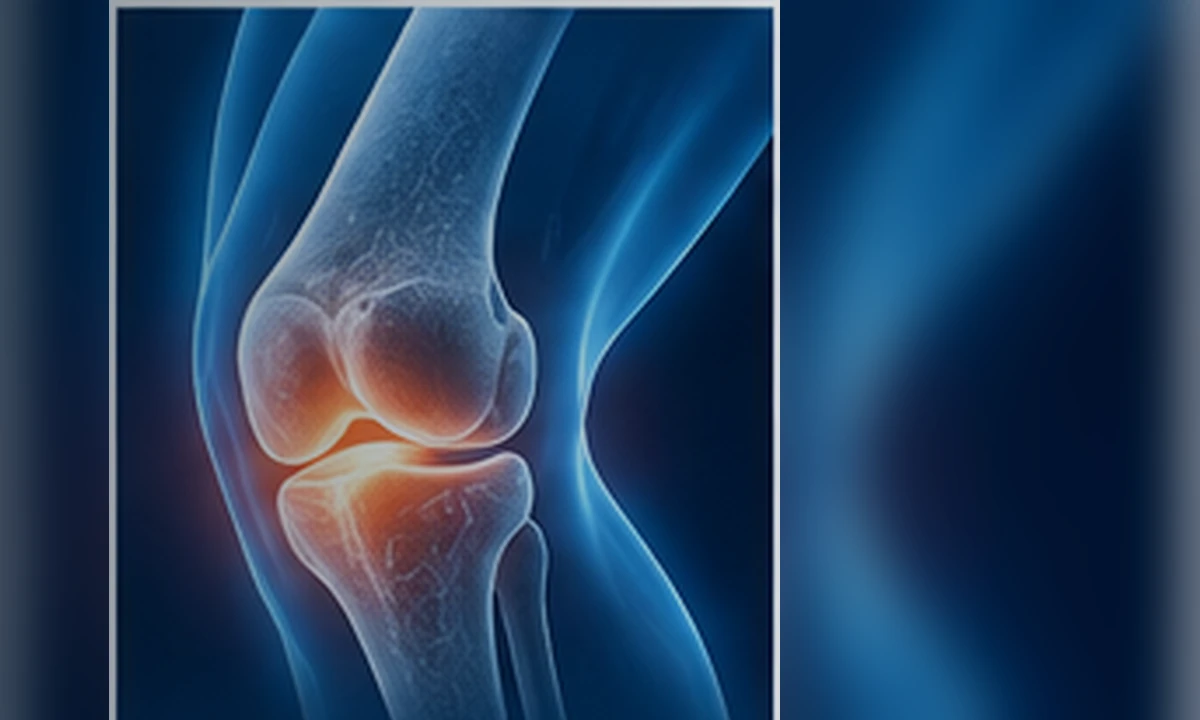 Medical illustration of knee osteoarthritis
